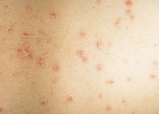 initial stage of psoriasis