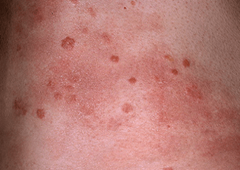 progressive stage of psoriasis