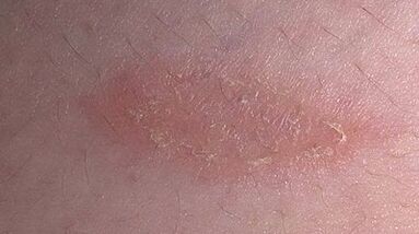 how and with what to treat psoriasis