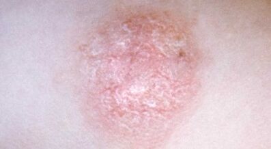how to recognize psoriasis at an early stage