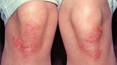 main manifestations of psoriasis