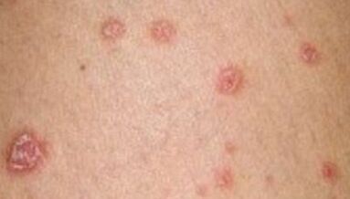 photo of psoriasis in the initial stage
