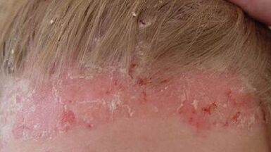 stages of development and symptoms of psoriasis