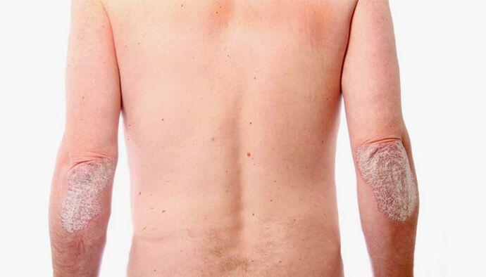 folk remedies for the treatment of psoriasis