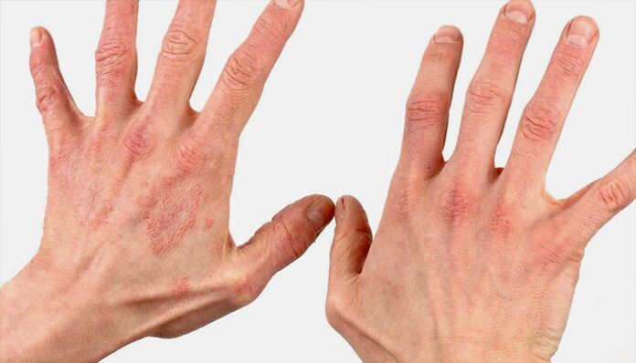 methods of treating psoriasis with folk remedies