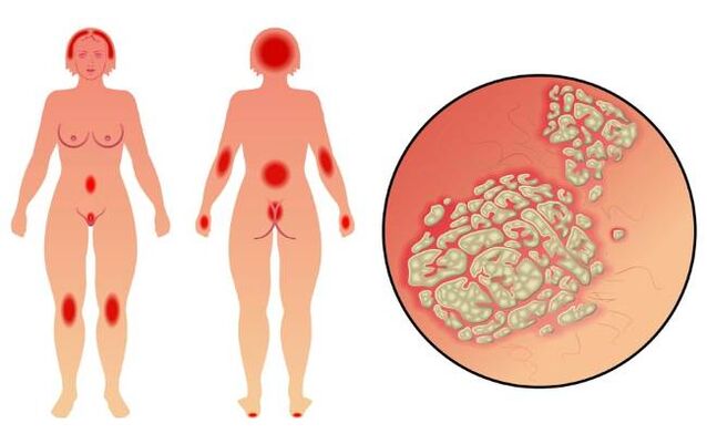 Symptoms of psoriasis
