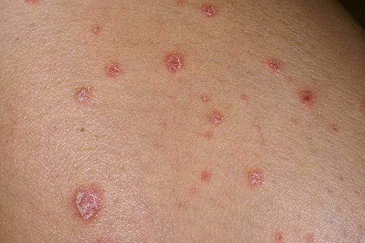 The causes of psoriasis