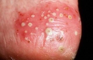 Psoriasis is pustular