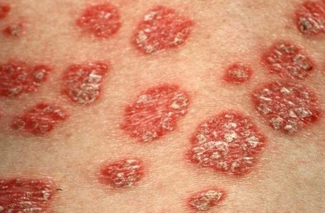 Psoriatic papules