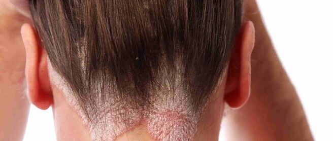 Psoriasis of the head