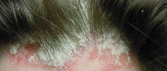 Psoriasis on the head
