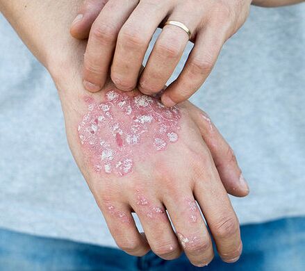 Psoriasis on the arm
