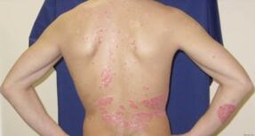 Treatment of the disease