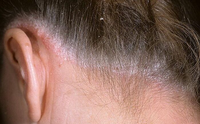 Psoriasis in the hair