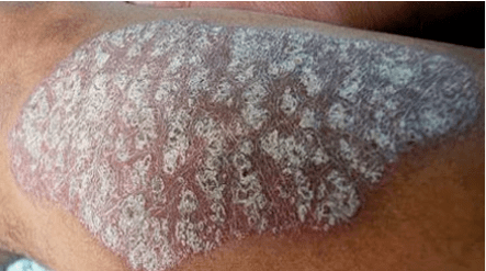 Pathogenesis of psoriasis
