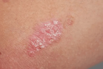 Psoriasis - initial stage