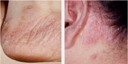 Types of psoriasis