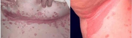 Atypical form of psoriasis