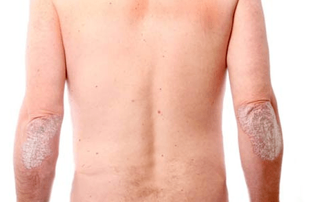 General symptoms of psoriasis