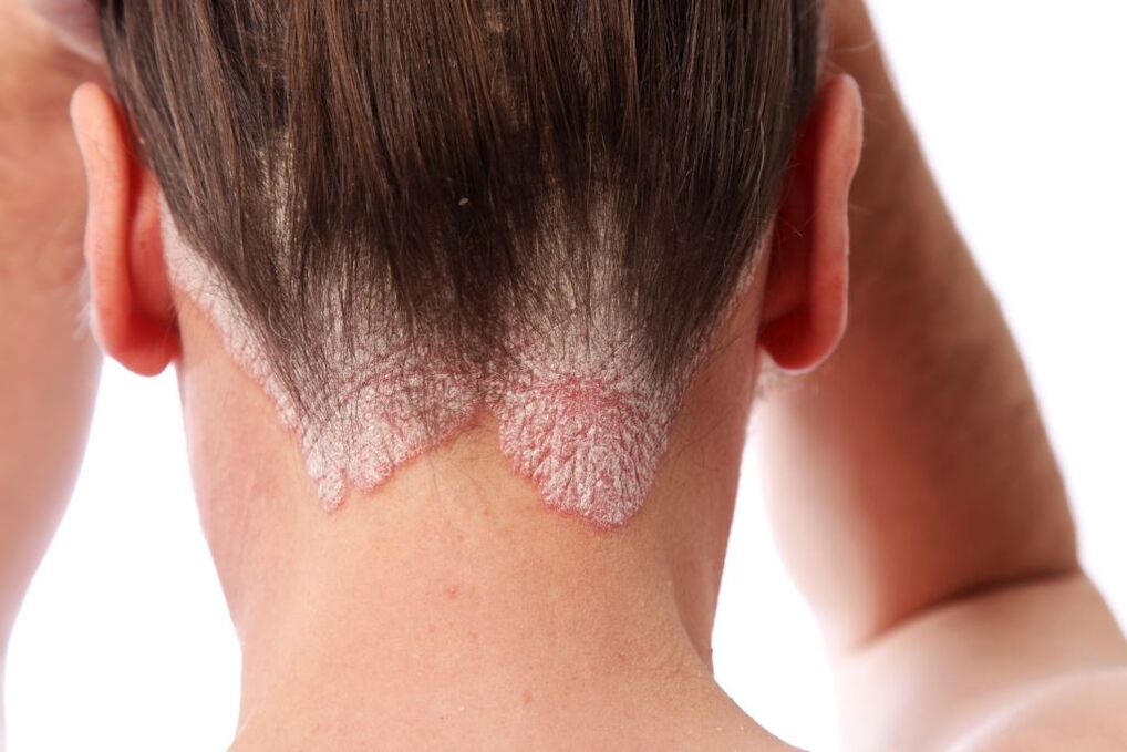 psoriasis treatment