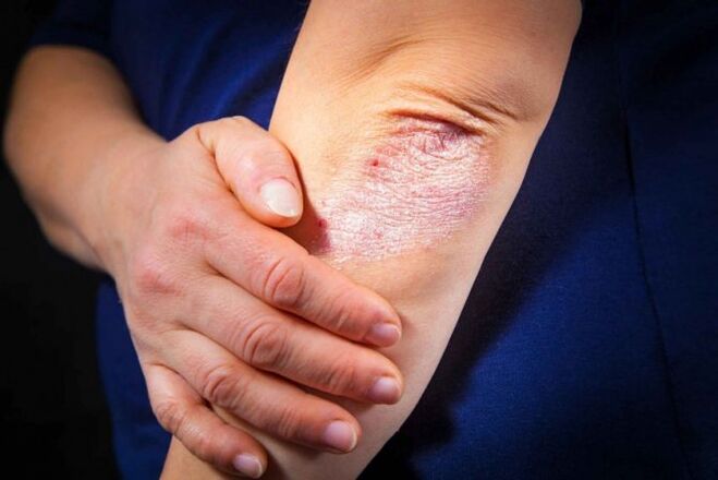 Psoriasis at home