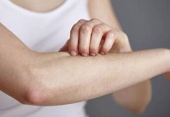 Psoriasis on the hand