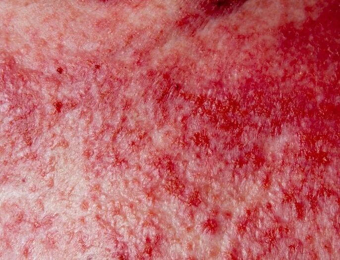 Advanced form of psoriasis