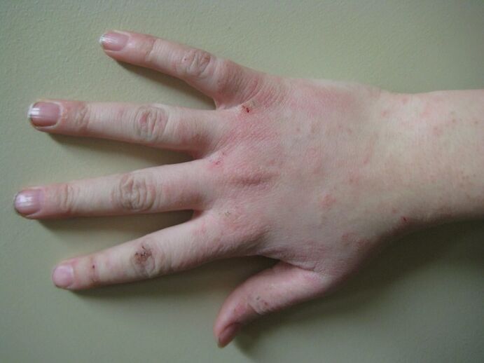 Psoriasis at an early stage