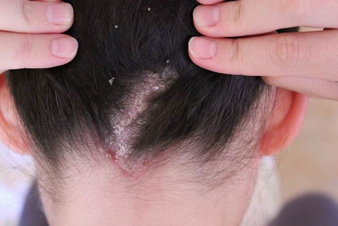 Psoriasis on the head