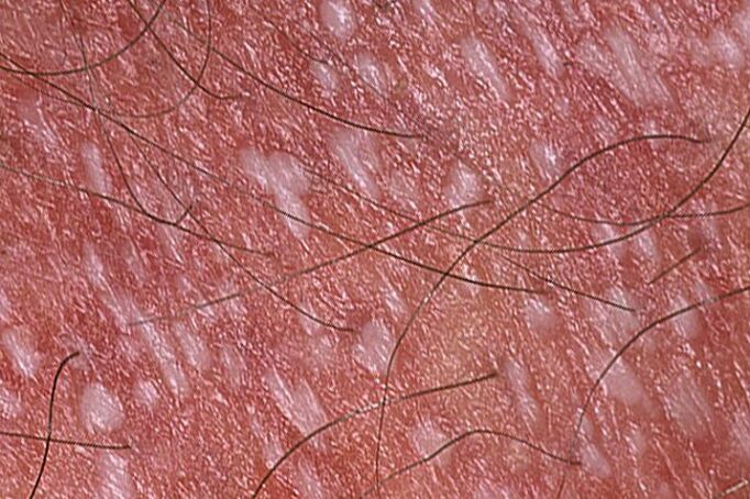 Pustular psoriasis
