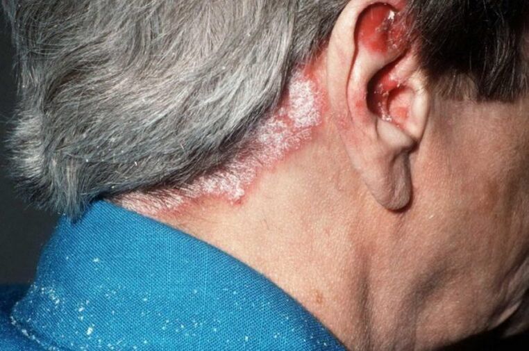 Psoriasis on the head