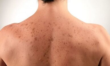 reasons for the development of psoriasis