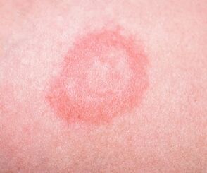 Initial stage of psoriasis