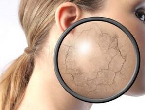 How does psoriasis manifest
