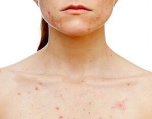 On what parts of the body does psoriasis appear