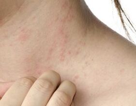main symptoms of psoriasis