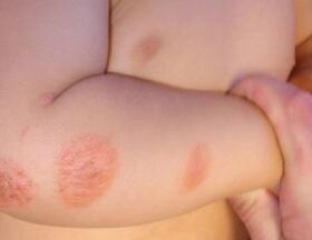 symptoms of psoriasis in children