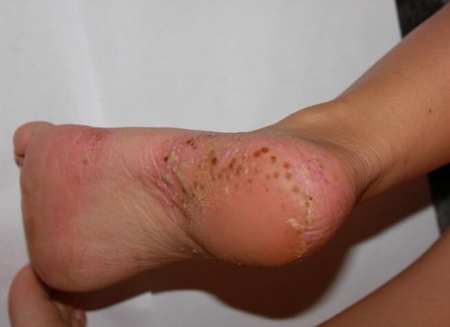 Palmoplantar psoriasis