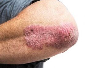 Plaque psoriasis on the elbow