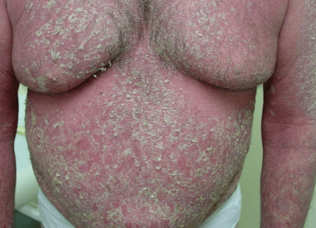 Psoriatic erythroderma on the body