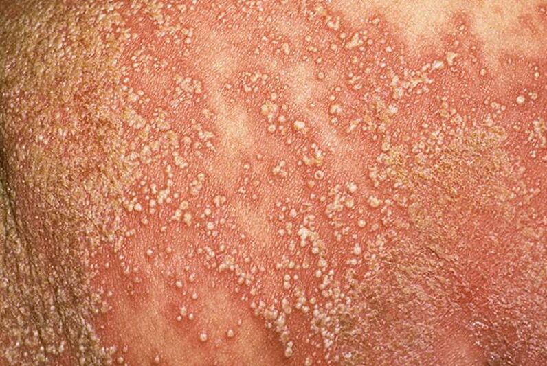 Pustular psoriasis