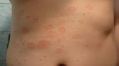 Psoriasis on the body