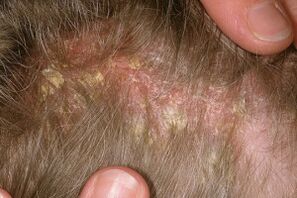Psoriasis on the head