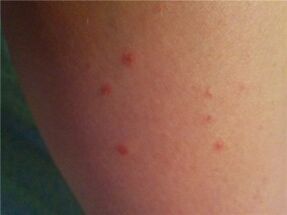 Psoriasis on the skin