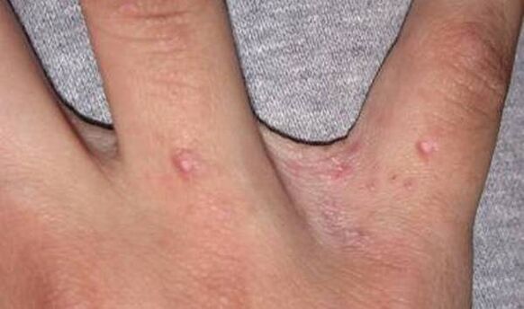 The beginning of psoriasis