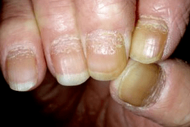 Nail psoriasis