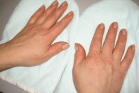 Psoriasis of fingernails